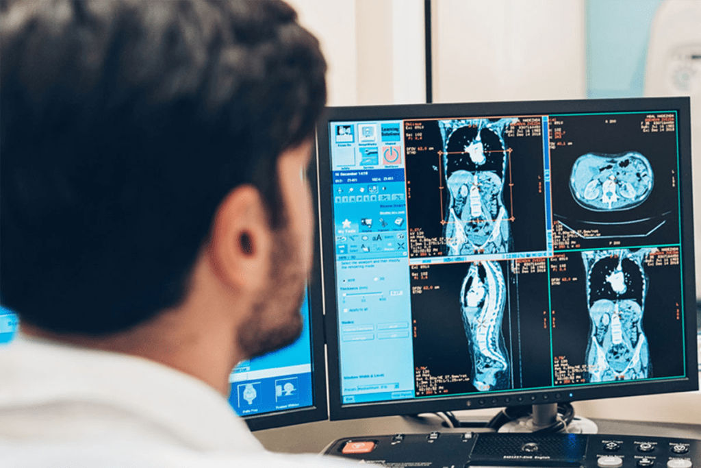 50 Cancer Test Galleri: Multi-Cancer Early Detection Blood Test Explained