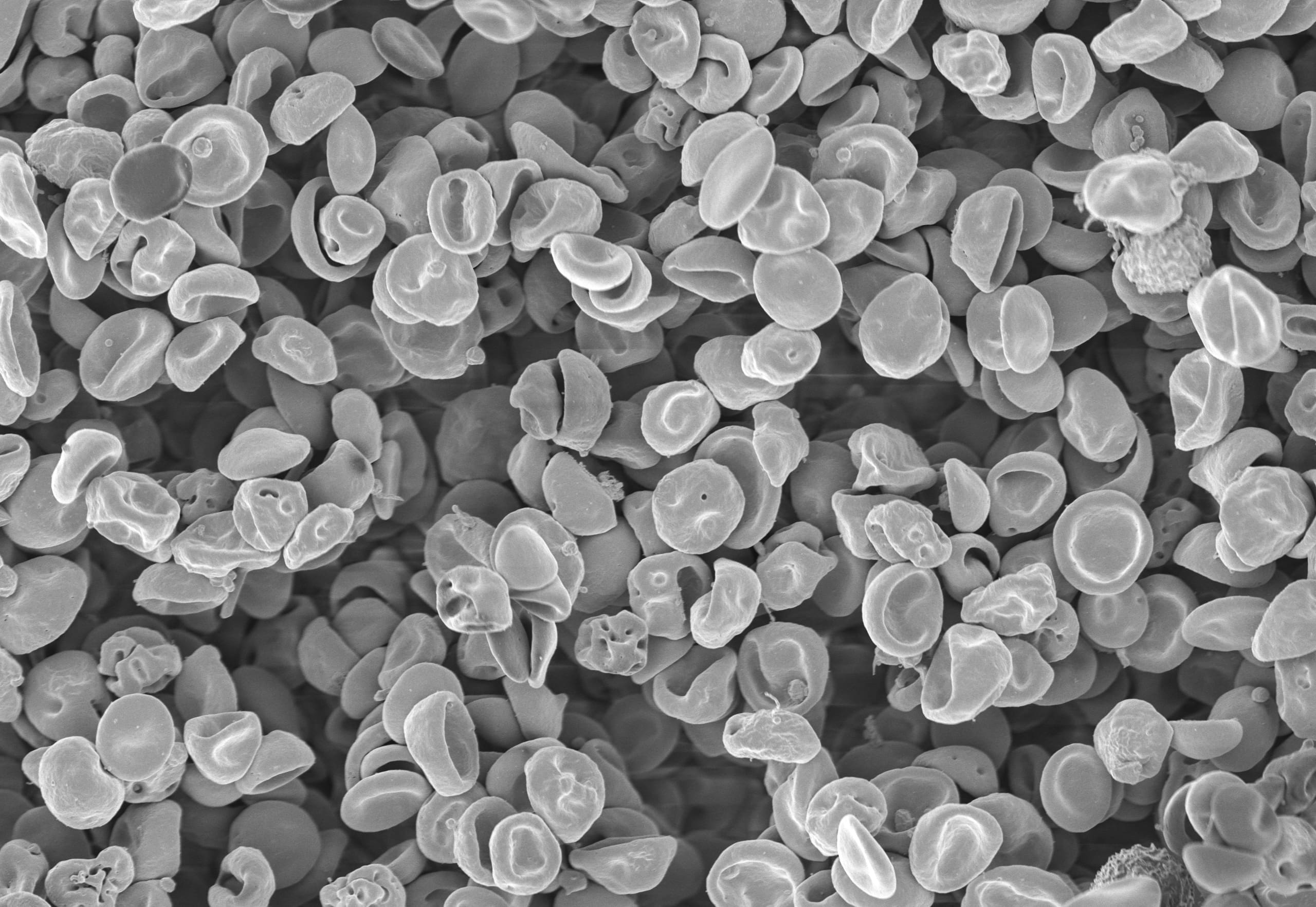 body reject a bone marrow transplant