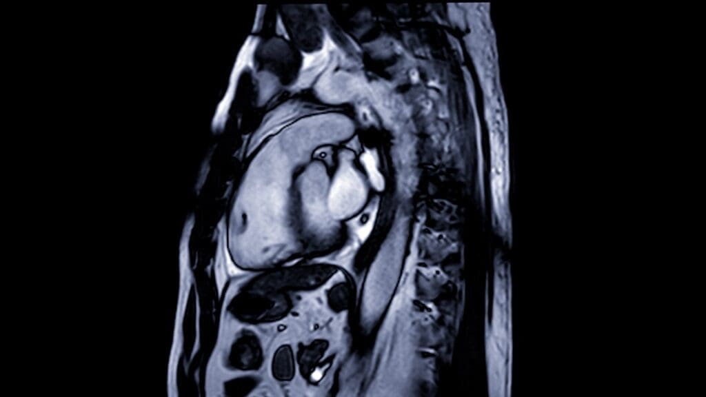 Cardiac MRI Scan