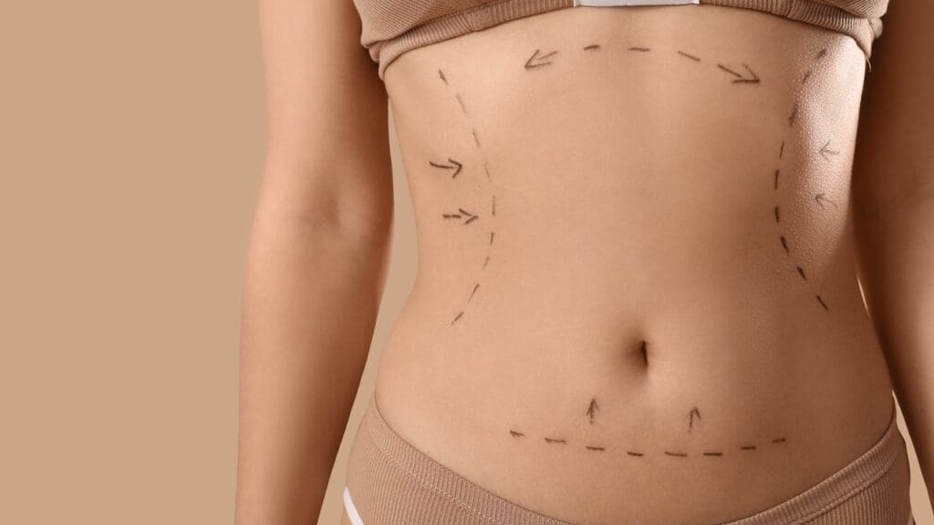 Abdominoplasty Surgery