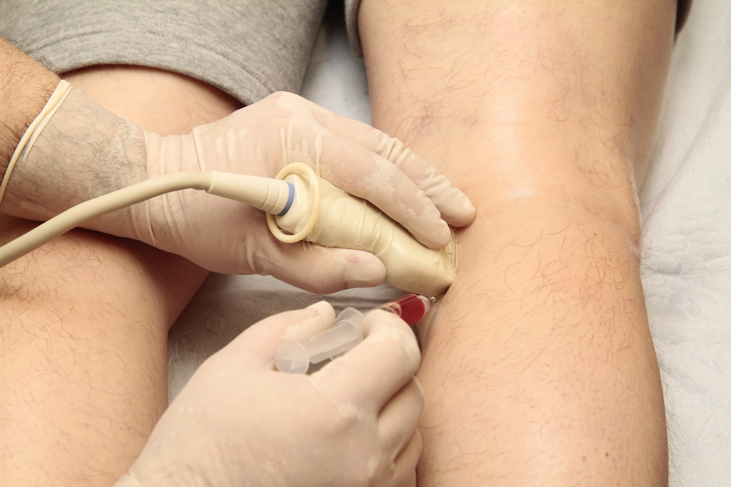 Stem Cell Injections