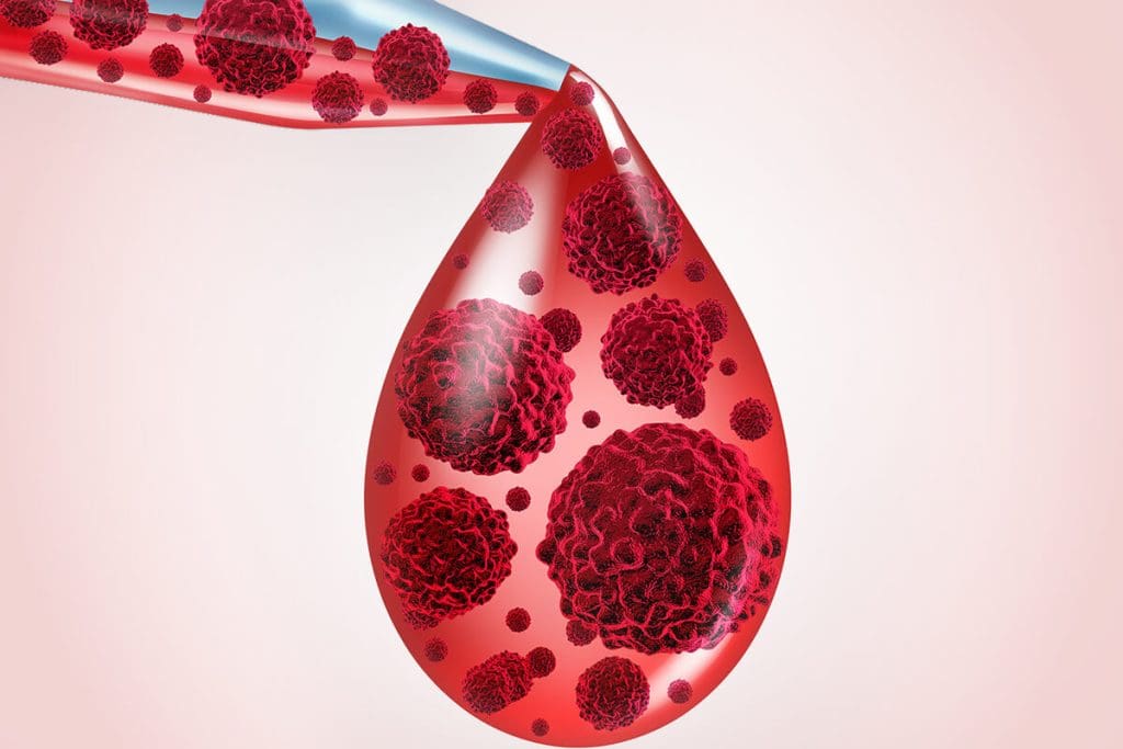 Anemia Symptoms: Crucial Biggest Blood Cancer Sign 1 Anemia Symptoms: Crucial Biggest Blood Cancer Sign