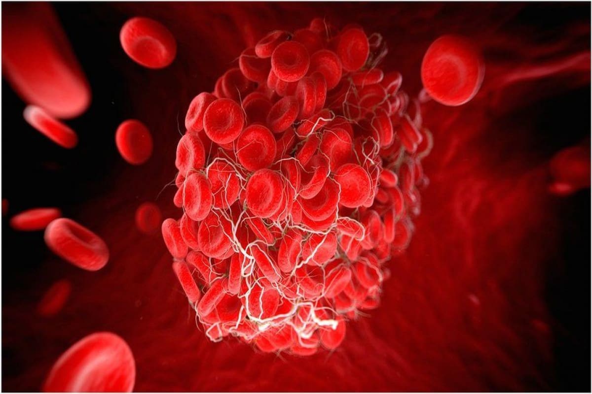 Thrombocytosis and High Platelet Count: Negative Risk