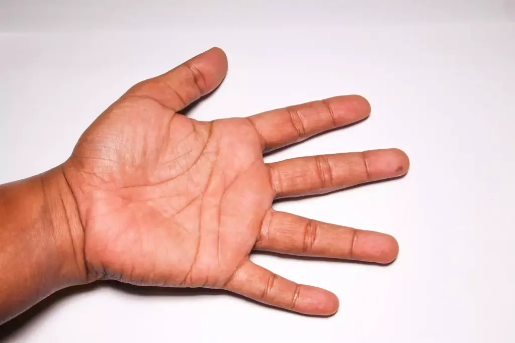 A close-up view of a human hand, highlighting the key indicators of carpal tunnel syndrome severity. The hand is positioned in a neutral, relaxed pose, showcasing the telltale signs - swollen and inflamed tendons, visible bulging of the median nerve, and a slight curvature in the wrist joint. Crisp, high-resolution details capture the texture of the skin and underlying structures, conveyed through a muted, clinical color palette. Soft, diffused lighting emphasizes the contours and accentuates the anatomical features, allowing for a clear, diagnostic-style examination of the condition. The composition places the hand centrally, filling the frame to draw the viewer's full attention to the focal subject.
