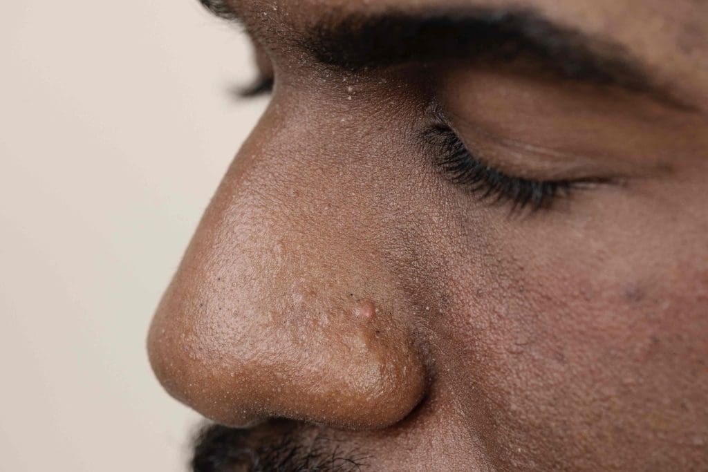 A close-up view of a human nose, showcasing a visible basal cell carcinoma growth