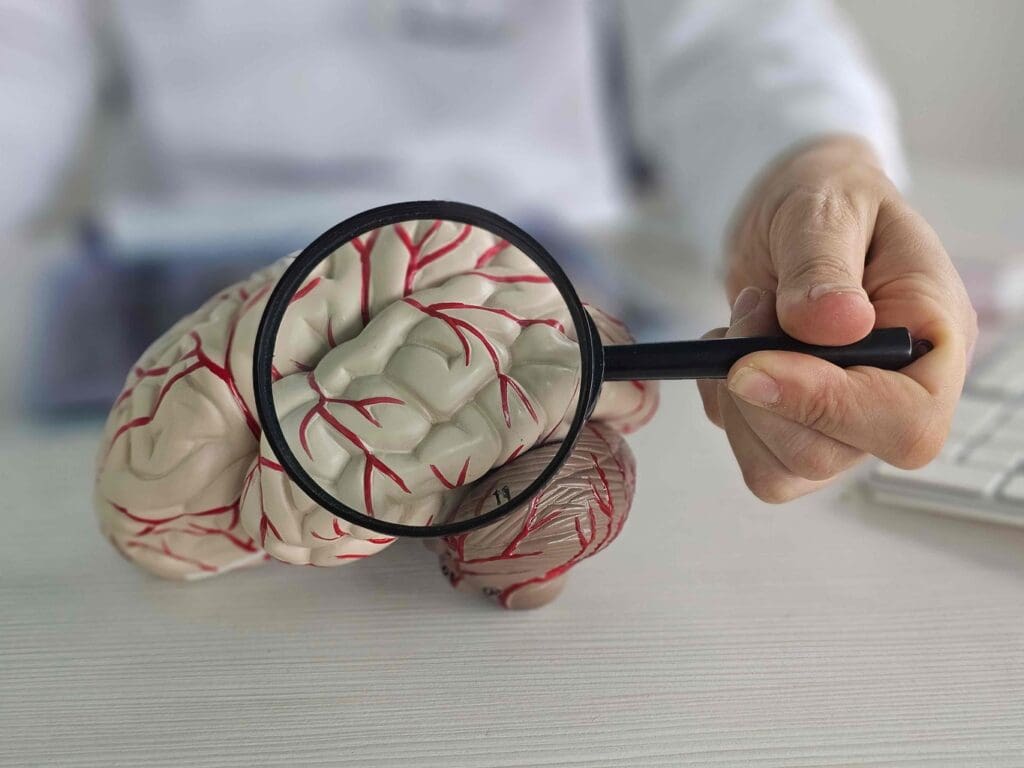 A detailed anatomical cross-section of a cerebral arteriovenous malformation (AVM) A detailed anatomical cross-section of a cerebral arteriovenous malformation (AVM)