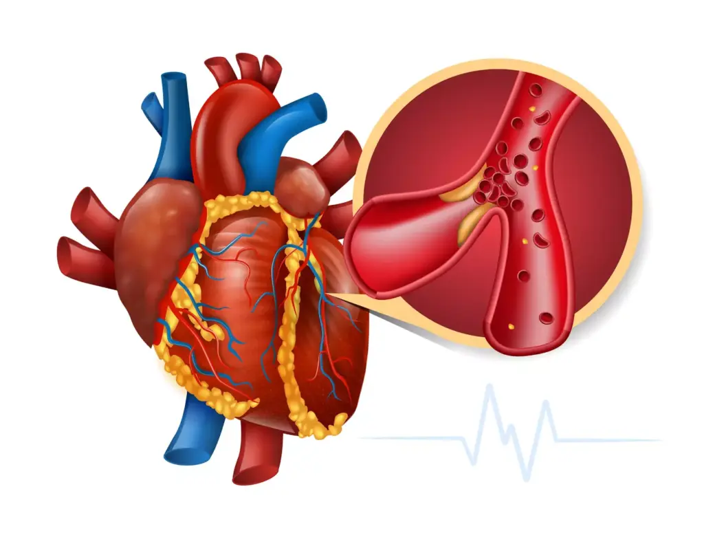 A detailed anatomical cross-section of a myocardial infarction, commonly known as a heart attack. In the foreground, the damaged and necrotic myocardium is clearly visible, surrounded by a buildup of plaque and thrombus in the coronary arteries. The middle ground depicts the surrounding cardiac structures, including the pericardium, endocardium, and valves, all rendered with medical precision. The background is a muted, monochromatic palette, creating a clinical, diagnostic atmosphere. Crisp, high-resolution details, balanced lighting, and a shallow depth of field focus the viewer's attention on the critical elements of the myocardial infarction.