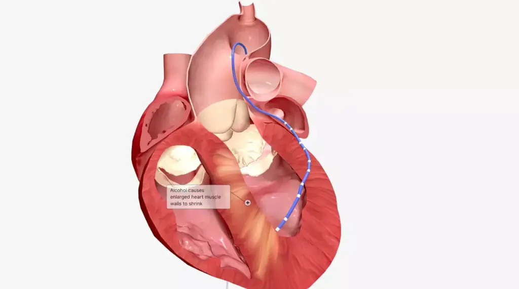 A detailed anatomical diagram showcasing the intricate structure of the atrioventricular valves within the human heart. The foreground depicts the mitral and tricuspid valves in vivid detail, capturing their delicate cusps, chordae tendineae, and papillary muscles. The middle ground reveals the surrounding cardiac chambers, including the atria and ventricles, rendered with precise anatomical accuracy. The background features a neutral, minimalist setting, allowing the viewer to focus on the valvular mechanism. The lighting is soft and diffused, highlighting the intricate textures and translucent qualities of the cardiac tissues. The overall composition is balanced and aesthetically pleasing, conveying a sense of scientific curiosity and medical understanding.