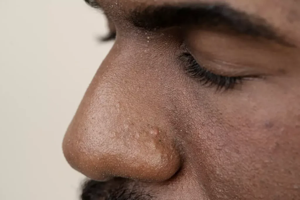 A detailed close-up of a basal cell carcinoma on the tip of a person's nose. The skin has a reddish, scaly, and slightly raised lesion with a pearly white border. The lighting is soft and diffuse, creating subtle shadows that emphasize the textural details of the affected area. The background is blurred, keeping the focus on the central subject. The overall mood is clinical yet empathetic, conveying the medical nature of the condition while retaining a sense of compassion for the person affected.