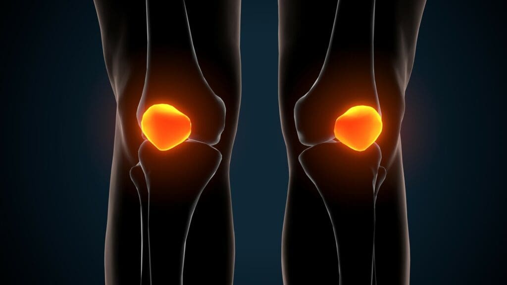 A detailed, close-up view of a human knee joint, revealing the localized damage caused by osteoarthritis A detailed, close-up view of a human knee joint, revealing the localized damage caused by osteoarthritis