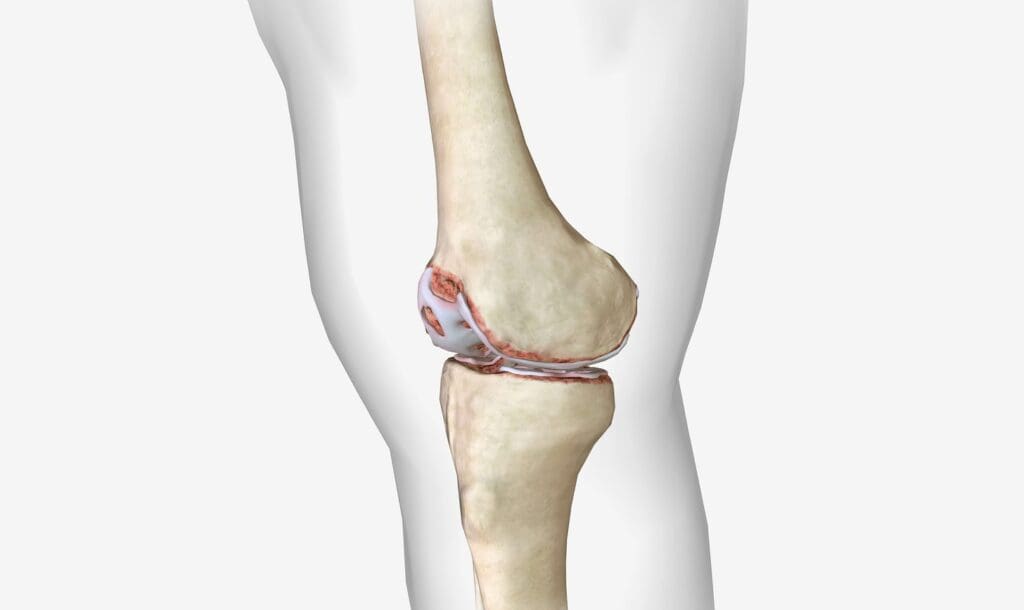 A detailed cross-section of a human knee joint, depicting the progressive stages of osteoarthritis.