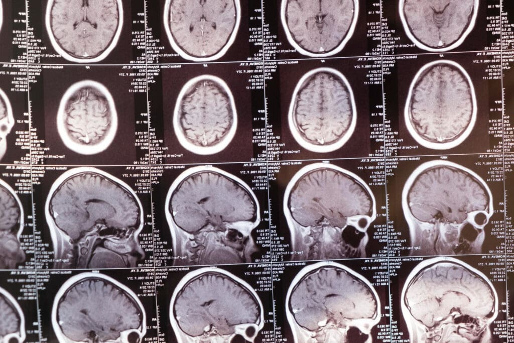 A detailed cross-section of the brain, showcasing the various types of brain tumors. Depicted in muted, anatomical tones, with a focus on the tumor structures and their distinctive characteristics. The image should convey a sense of medical precision and scientific understanding, allowing the viewer to clearly distinguish between the different tumor types and their potential impact on the brain. The composition should be balanced, with a clear hierarchy of visual elements, guiding the viewer's attention to the key tumor features. Lighting should be soft and diffused, creating a sense of depth and dimension within the image. The overall mood should be informative and educational, supporting the understanding of brain cancer types and prognosis. A detailed cross-section of the brain, showcasing the various types of brain tumors. Depicted in muted, anatomical tones, with a focus on the tumor structures and their distinctive characteristics. The image should convey a sense of medical precision and scientific understanding, allowing the viewer to clearly distinguish between the different tumor types and their potential impact on the brain. The composition should be balanced, with a clear hierarchy of visual elements, guiding the viewer's attention to the key tumor features. Lighting should be soft and diffused, creating a sense of depth and dimension within the image. The overall mood should be informative and educational, supporting the understanding of brain cancer types and prognosis.