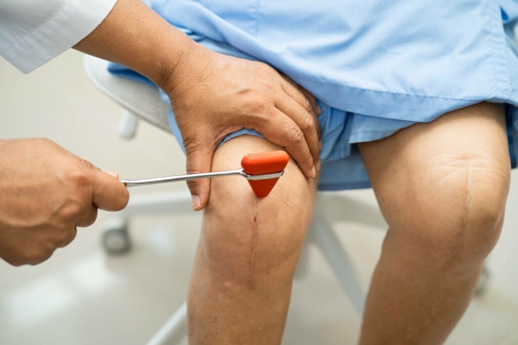 A detailed cross-section view of a knee joint during a replacement surgery