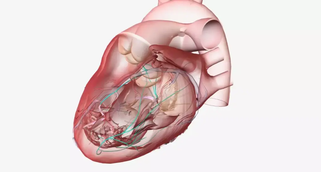 A detailed, cross-sectional view of a human heart experiencing a myocardial infarction. In the foreground, the heart muscle is shown to be damaged and discolored, with areas of ischemia and necrosis. The coronary arteries are occluded, preventing oxygen-rich blood from reaching the affected region. In the middle ground, the pericardium and surrounding tissues are inflamed, with visible signs of edema and fluid buildup. The background is a clean, clinical environment, with soft, directional lighting illuminating the scene from an angle that emphasizes the three-dimensional structure of the heart. The overall mood is one of medical urgency and the need for immediate intervention to restore blood flow and prevent further damage.