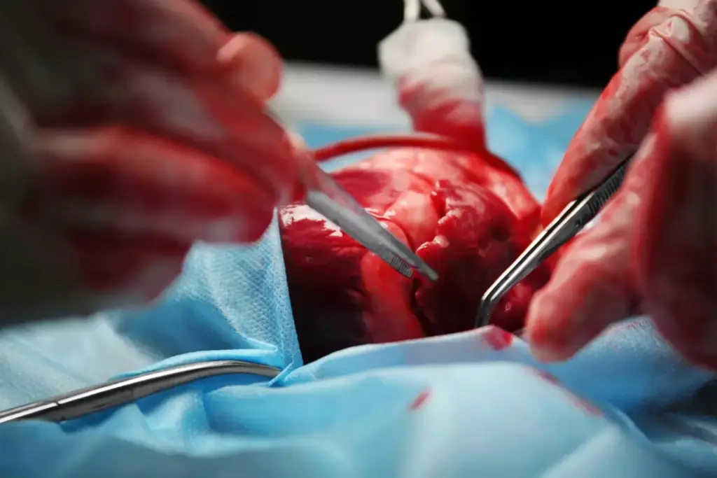 A detailed surgical procedure capturing the intricate steps of laparoscopic endometriosis excision. In the foreground, a minimally invasive camera gently navigates through the pelvic cavity, illuminating the affected endometrial lesions. The middle ground reveals the surgeon's skilled hands precisely removing the diseased tissue, restoring the natural anatomy. The background showcases the advanced medical equipment, the sterile environment, and the collaborative healthcare team closely monitoring the delicate operation. Soft, warm lighting casts a clinical yet reassuring glow, conveying the professionalism and care underlying this gold standard treatment for endometriosis.