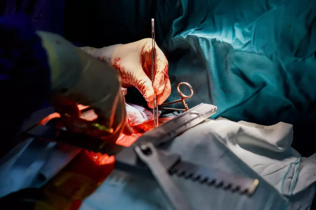 A detailed view of an ongoing bone graft surgery, showcasing the intricate biological process. In the foreground, a surgeon carefully removes a section of the patient's bone, exposing the underlying structure. The middle ground highlights the grafted bone segment, its porous nature visible, ready to be implanted. In the background, a dynamic interplay of surgical instruments, sterile medical equipment, and a soft, ambient lighting create a sense of medical precision. The overall atmosphere conveys the delicate and complex nature of this procedure, essential for understanding the biological foundations of a bone graft.