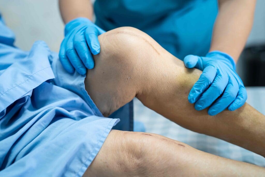 A knee joint in the post-operative stage A knee joint in the post-operative stage