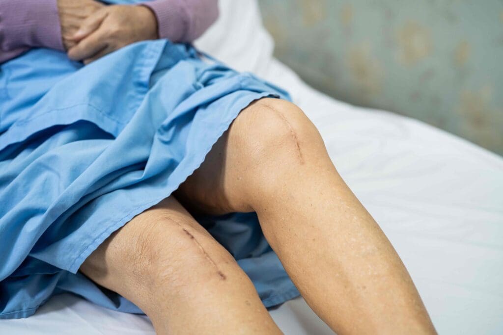 A swollen knee resting on a soft, white bedsheet