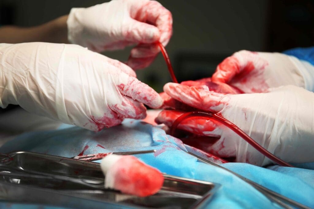 AVM embolization procedure