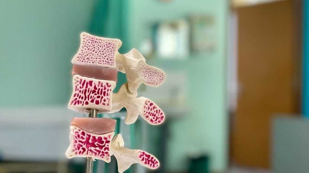 About Spinal Tumor Survival About Spinal Tumor Survival