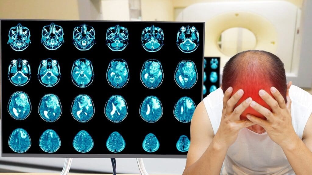 Acute Disseminated Encephalomyelitis Symptoms 