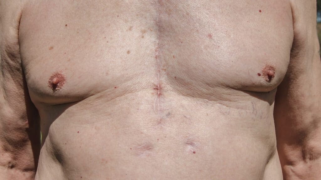 Anatomy of Heart Valve Replacement Scars