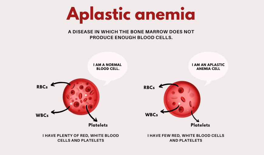 Aplastic Anemia Treatment in Delhi Dr Vikas Dua LIV Hospital