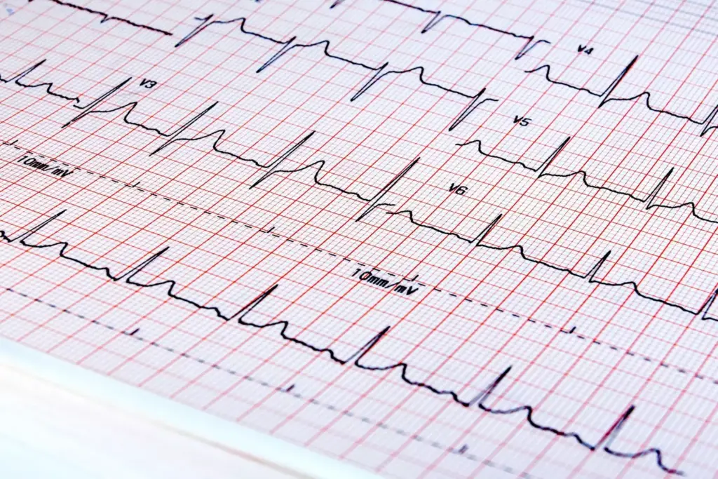 Atrial fibrillation prevalence statistics: a series of meticulously designed infographic elements displayed on a clean, minimalist background. In the foreground, a collection of vibrant bar graphs and line charts showcase the incidence and trends of this cardiac condition across different demographics and regions. The middle ground features delicate anatomical illustrations of the heart, highlighting the affected atrial chambers. The background subtly blends shades of blue and gray, creating a sense of medical authority and professionalism. Soft lighting casts gentle shadows, enhancing the depth and clarity of the visualizations. The overall composition conveys a balanced, data-driven approach to understanding the scope and impact of atrial fibrillation. Atrial fibrillation prevalence statistics: a series of meticulously designed infographic elements displayed on a clean, minimalist background. In the foreground, a collection of vibrant bar graphs and line charts showcase the incidence and trends of this cardiac condition across different demographics and regions. The middle ground features delicate anatomical illustrations of the heart, highlighting the affected atrial chambers. The background subtly blends shades of blue and gray, creating a sense of medical authority and professionalism. Soft lighting casts gentle shadows, enhancing the depth and clarity of the visualizations. The overall composition conveys a balanced, data-driven approach to understanding the scope and impact of atrial fibrillation.