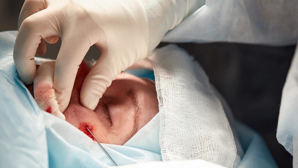 Basal Cell Carcinoma on the Nose with Mohs Surgery Basal Cell Carcinoma on the Nose with Mohs Surgery