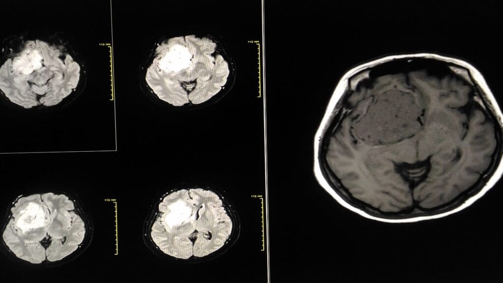 Brain Tumor Measurements Brain Tumor Measurements