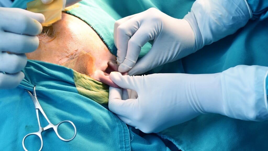 Burr Hole Surgery Recovery Time