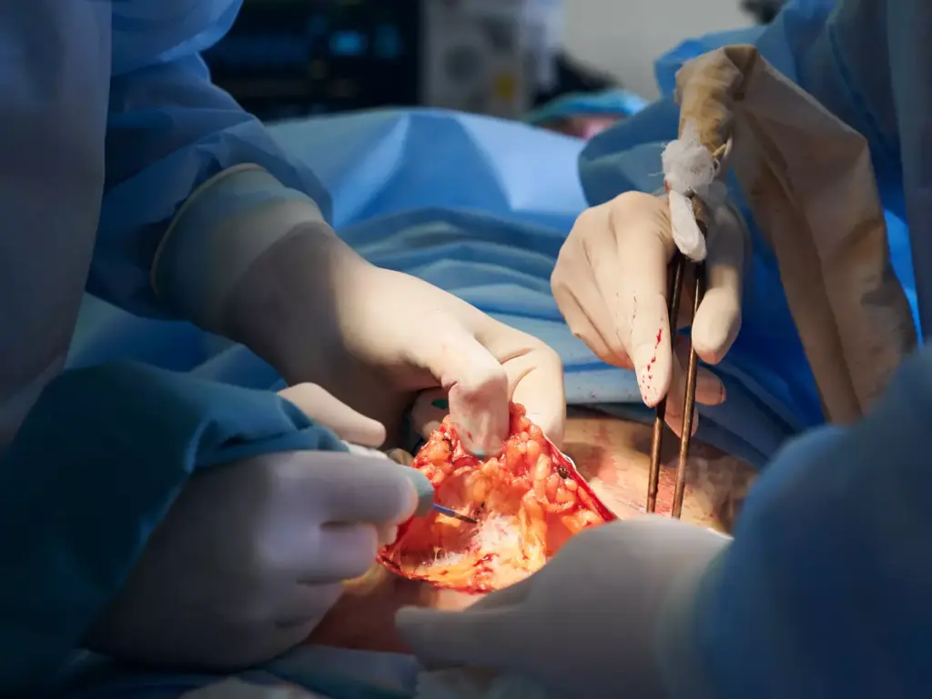 Coronary Artery Bypass Coronary Artery Bypass