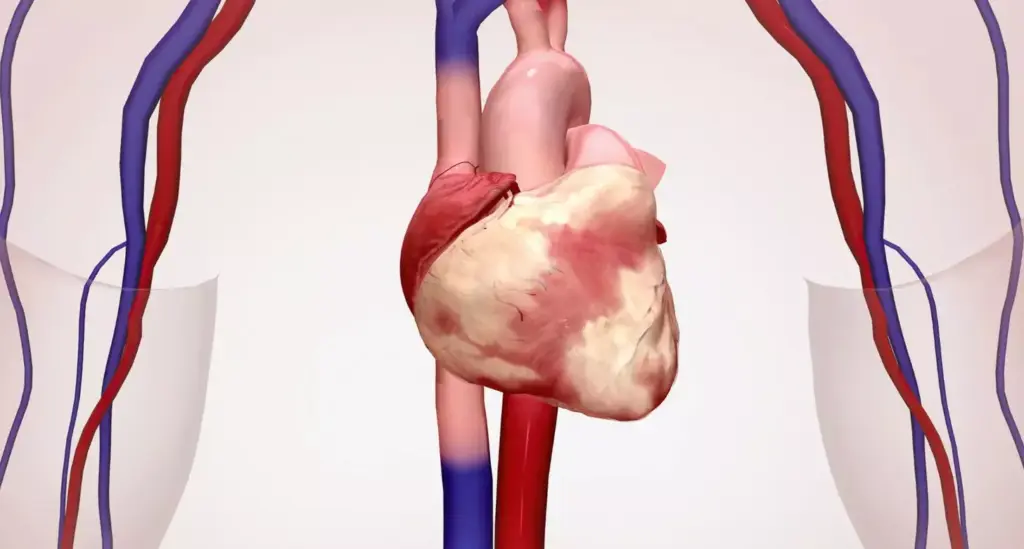 Detailed anatomical diagram of the human heart, showcasing the myocardial infarction. Precise illustration of the coronary circulation, with emphasis on the affected blood vessels and the damaged myocardial tissue. Crisp, technical rendering with a clean, neutral background, highlighting the key structures in a clear, informative manner. Soft, directional lighting from the top-left, casting subtle shadows to accentuate the three-dimensional form. Detailed cross-section view, captured at a slight angle to provide optimal visibility. Muted color palette, focusing on shades of red, blue, and gray to convey the medical subject matter. Overall, a comprehensive, visually striking representation suitable for educational purposes.