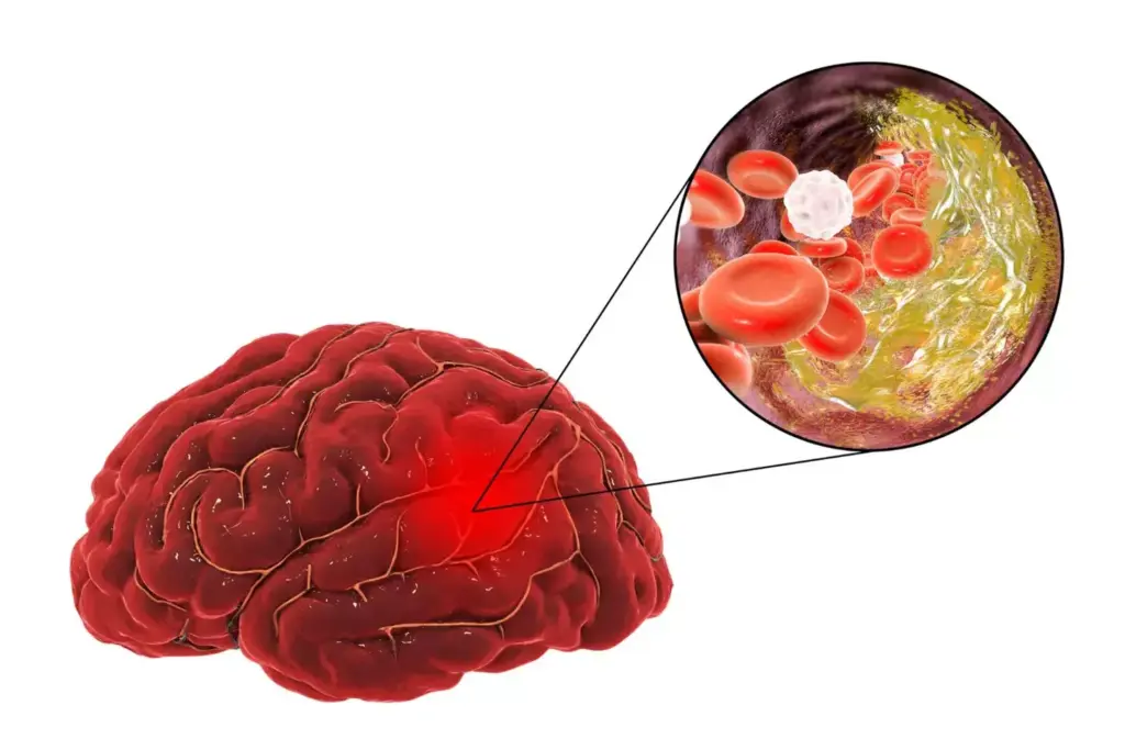 Detailed cross-section of a complex, infiltrating brain tumor, rendered in vivid scientific realism. Intricate glioma cells proliferating aggressively, invading healthy brain tissue. Highlighted regions of necrosis, hemorrhage, and vascular abnormalities. Chiaroscuro lighting emphasizes the tumor's sinister, three-dimensional structure, conveying the clinical challenges of such an aggressive malignancy. High-resolution micrograph-style perspective, with a narrow depth of field to focus attention on the tumor's ominous complexity. Detailed cross-section of a complex, infiltrating brain tumor, rendered in vivid scientific realism. Intricate glioma cells proliferating aggressively, invading healthy brain tissue. Highlighted regions of necrosis, hemorrhage, and vascular abnormalities. Chiaroscuro lighting emphasizes the tumor's sinister, three-dimensional structure, conveying the clinical challenges of such an aggressive malignancy. High-resolution micrograph-style perspective, with a narrow depth of field to focus attention on the tumor's ominous complexity.