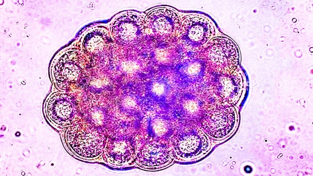 Diffuse Large B Cell Lymphoma