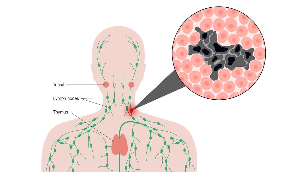 Diffuse Large B-Cell Lymphoma treatment