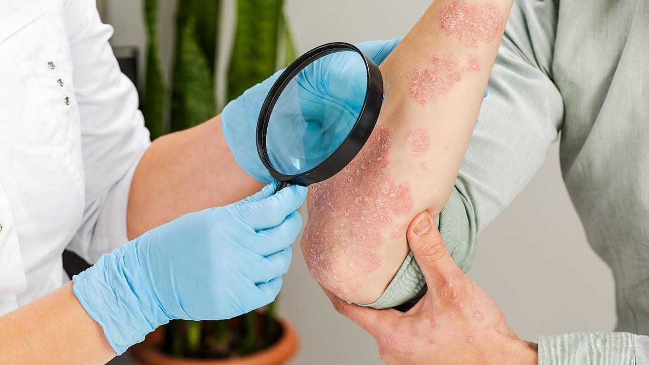 How Dangerous Is Melanoma