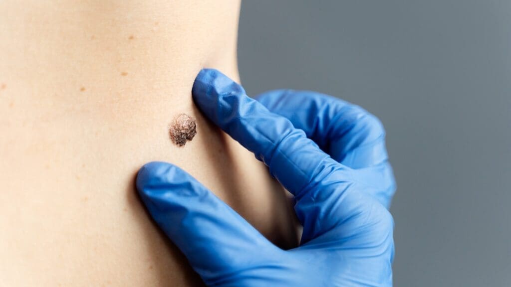 Remove Basal Cell Carcinoma