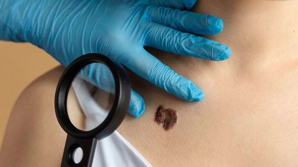 Remove Basal Skin Cancer: Step-by-Step Surgical Procedures