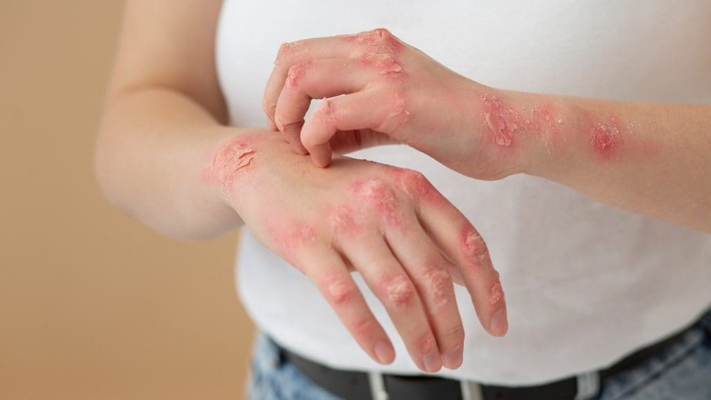 Skin Rash and Redness  in GVHD