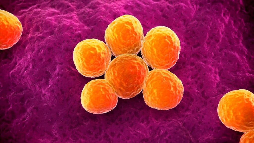 Stage 4 Large B Cell Lymphoma