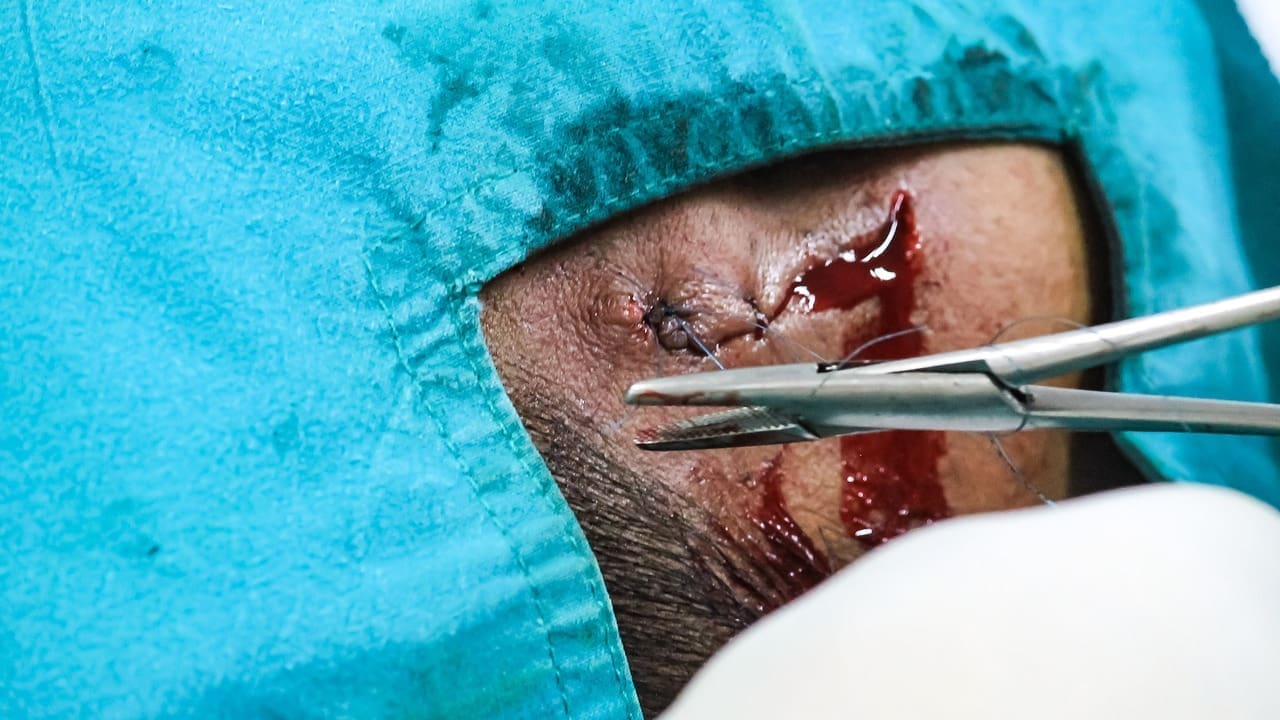 Surgery for Basal Cell Carcinoma