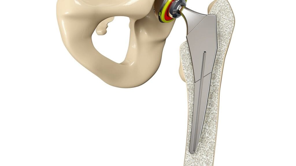 Titanium Artificial Hip