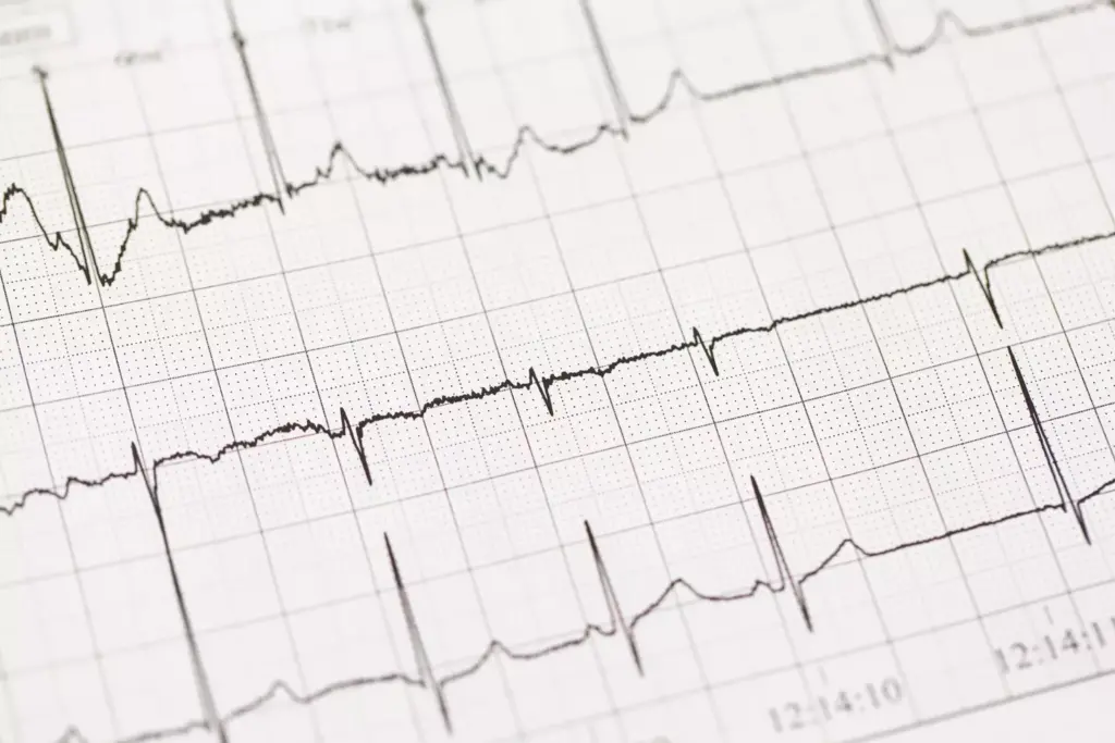 Understanding Atrial Fibrillation Understanding Atrial Fibrillation