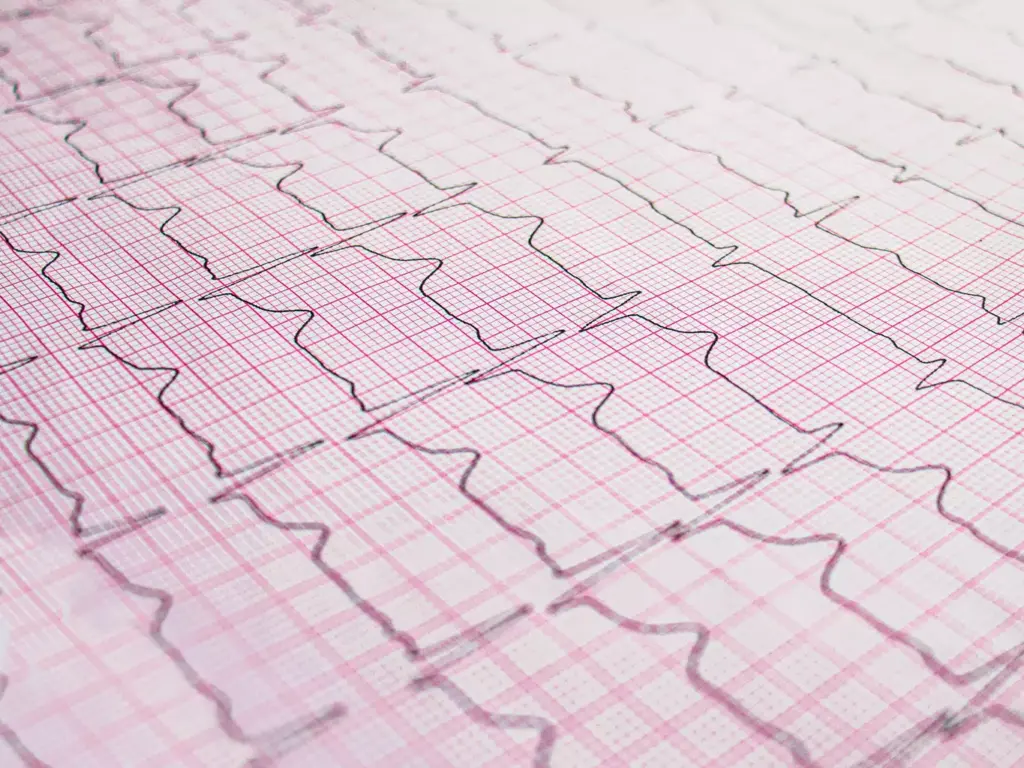 Understanding Atrial Fibrillation and Atrial Flutter