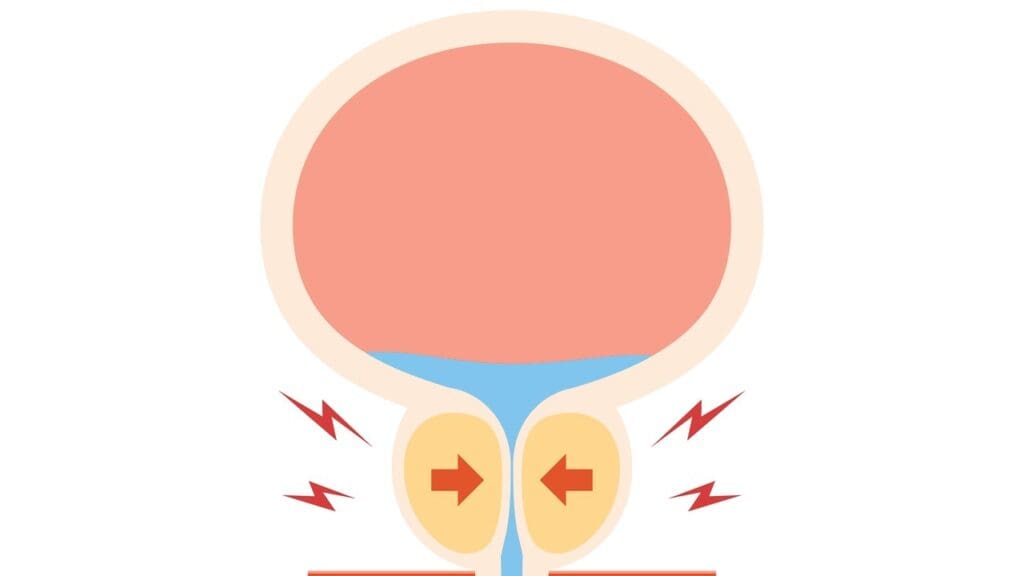 Understanding Benign Prostatic Hyperplasia Understanding Benign Prostatic Hyperplasia