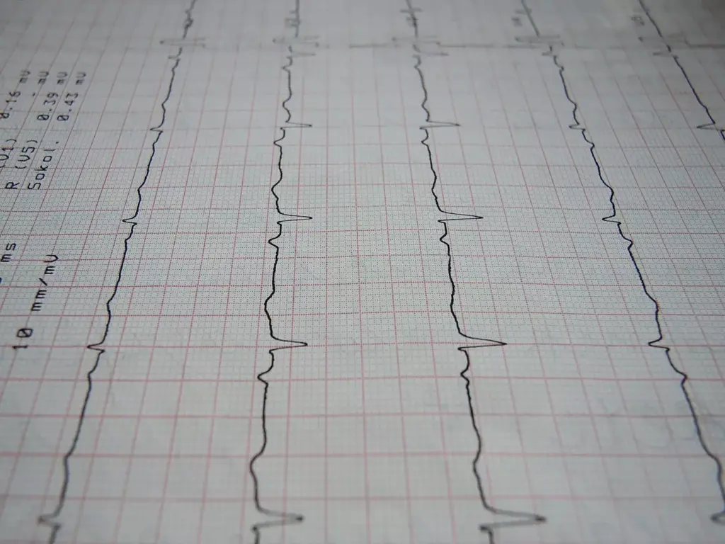 Understanding Heart Rhythm Basics