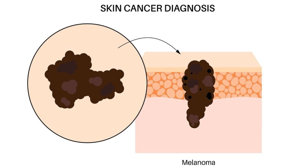 Understanding Skin Cancer Understanding Skin Cancer