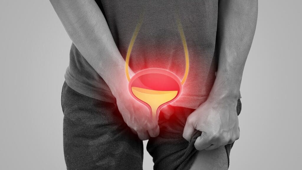 What Happens If Prostate Cancer Comes Back After Treatment?