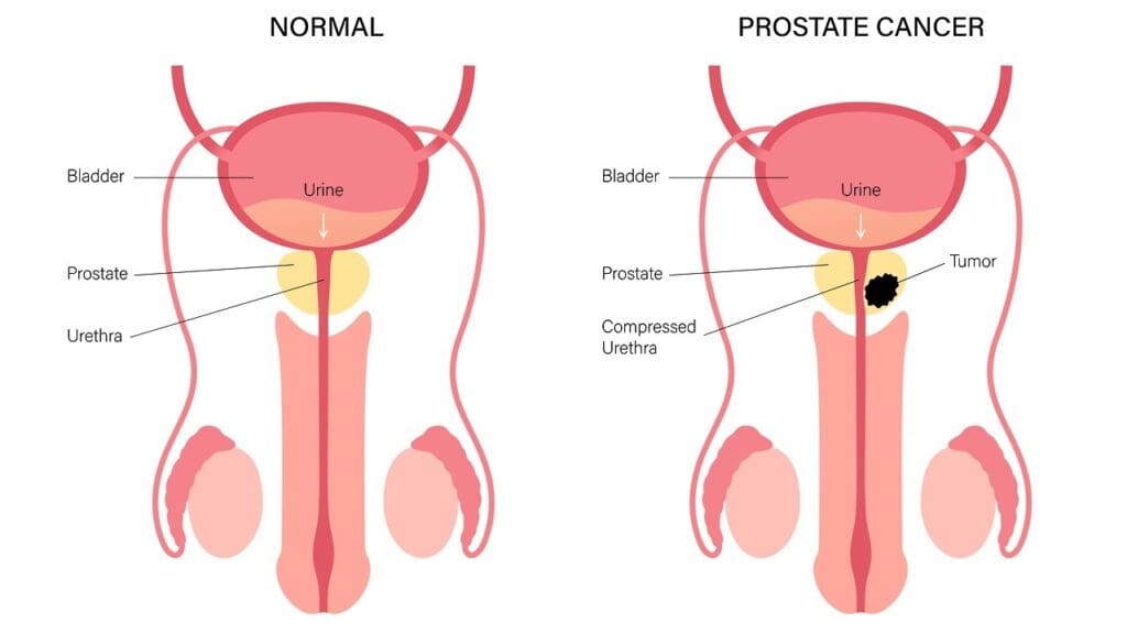 What Happens If a Man Lives Without a Prostate Gland?